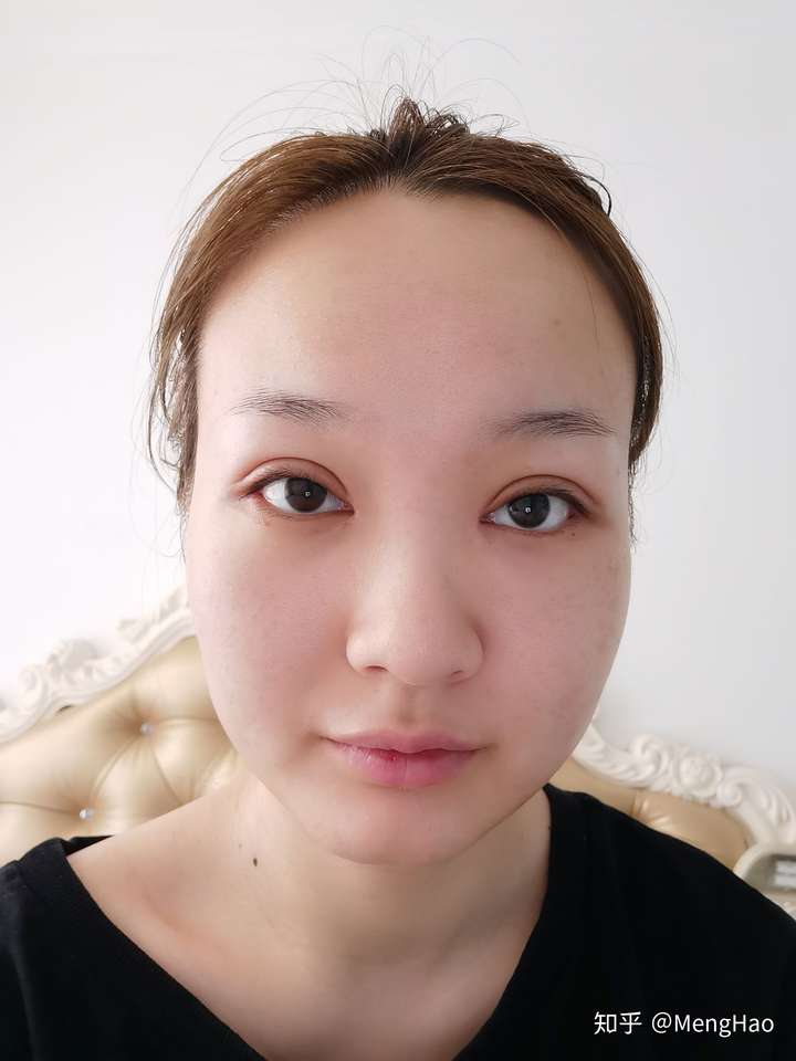 现在一个眼睛大一个眼睛小,不知道之后另一个眼角能不能也长着?