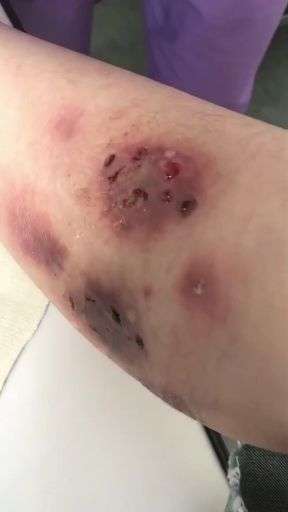 皮肤感染性窦道是怎么来的