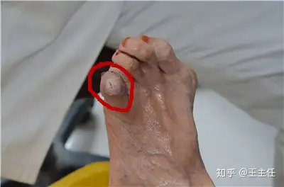 糖尿病患者脚趾畸形,更加容易出现糖尿病足
