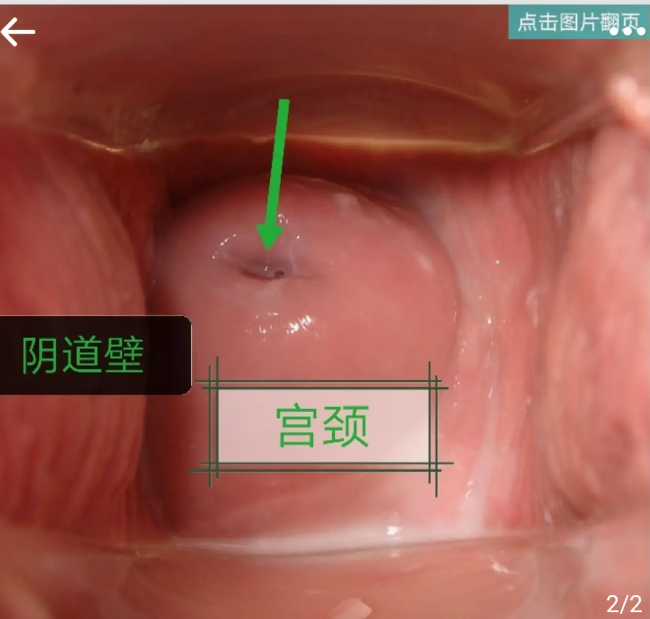 你的宫颈健康吗？（一）最全最专业的知识就在这里，拿走不谢- 知乎