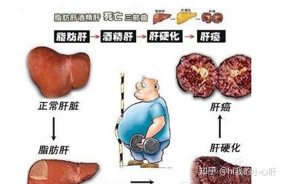 脂肪肝的治疗方法 知乎