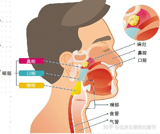 涕中带血耳鸣耳堵淋巴结肿大在我国高发的鼻咽癌该如何预防