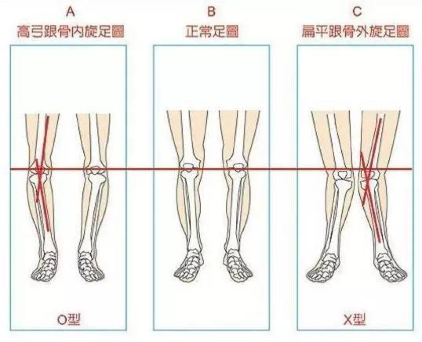 你根本就不知道你是扁平足 知乎