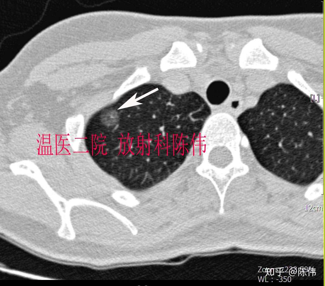 4例肺癌的典型影像学表现 知乎