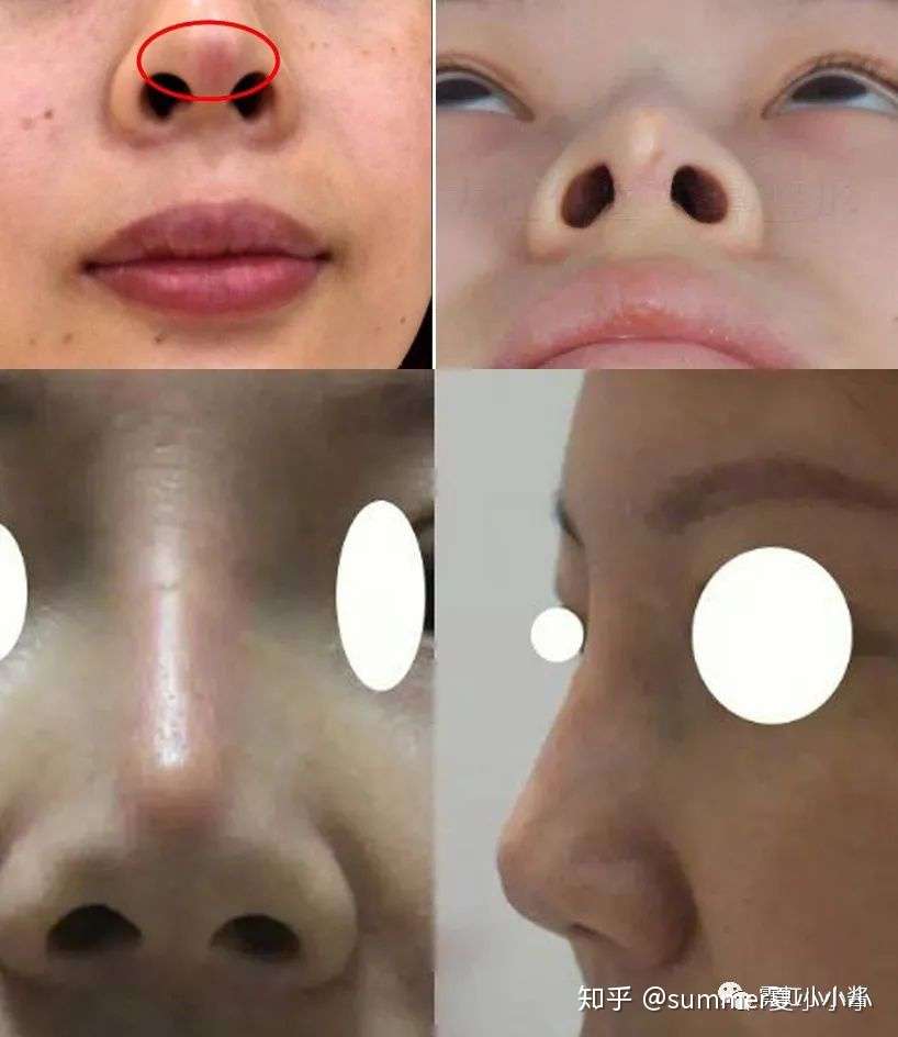 鼻子做成什么样才好看 一篇务实的鼻修复参考 一 日本医美 知乎