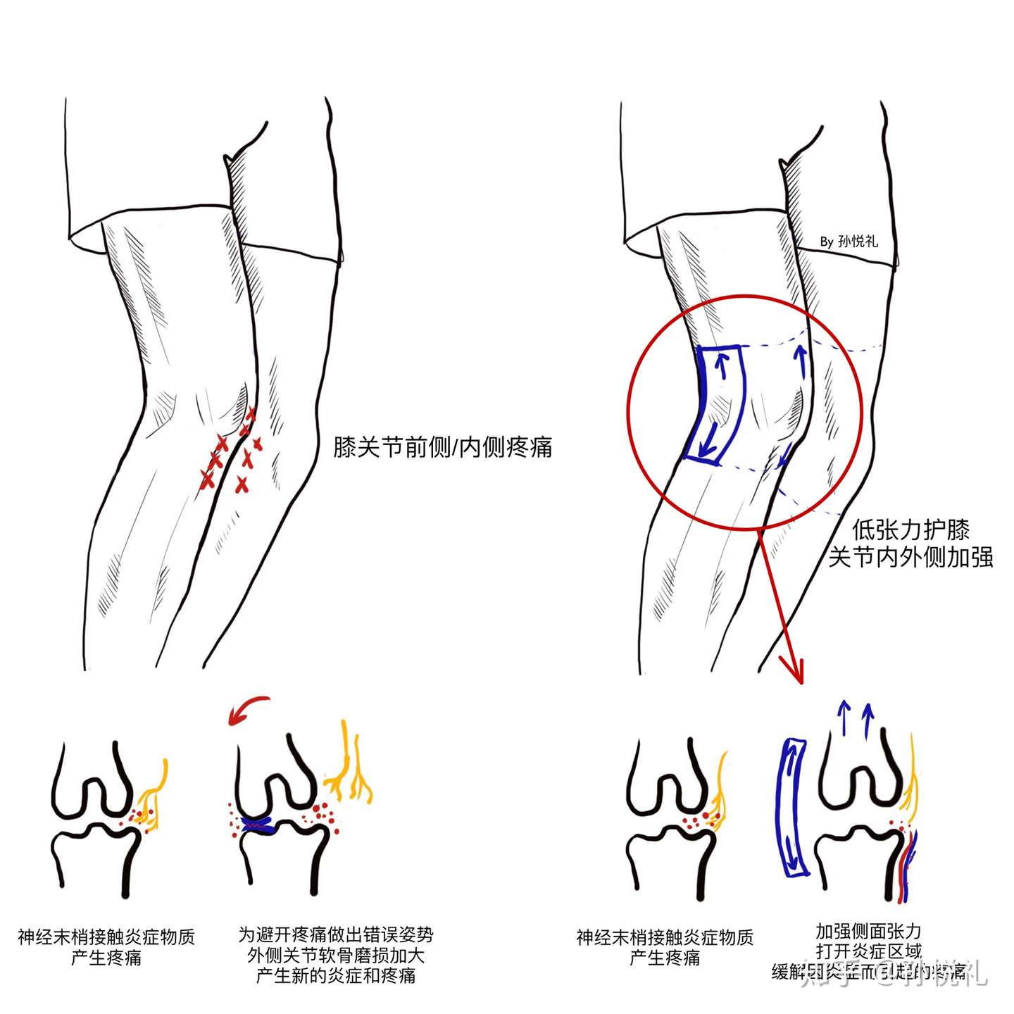 如何科学选用护膝 知乎