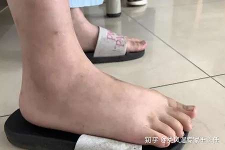 类风湿专家王主任 许多人认为"关节炎"是成年人才有的标签,殊不知儿童