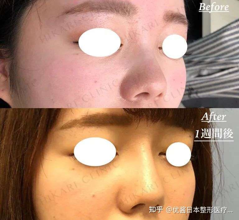 告别无效整形 为什么别人整完像 换头 你却整了个寂寞 知乎