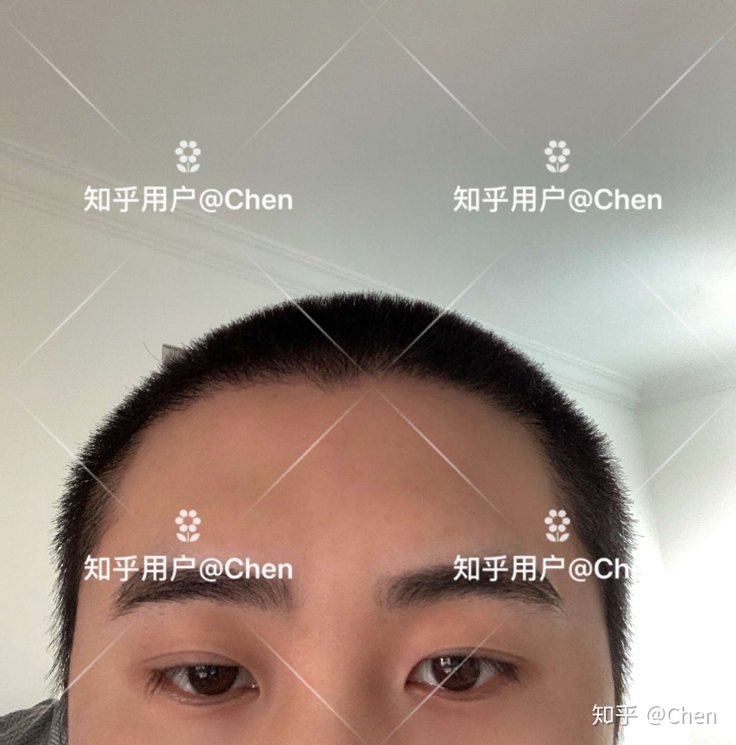 植发两年超详细术后恢复记录 含植发脱落期 知乎