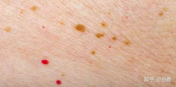 皮肤上有红点 是什么 知乎