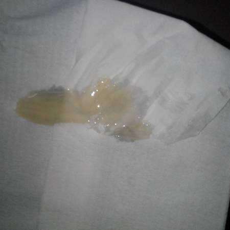 少精子症是指精液中的精子数目低于正常具