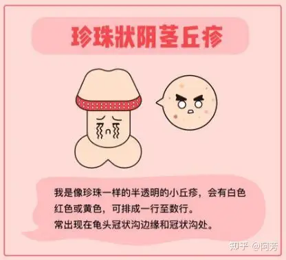 直径1-2mm,长度1-4mm,以一排或两排成簇状分布在龟头边缘和系带两侧