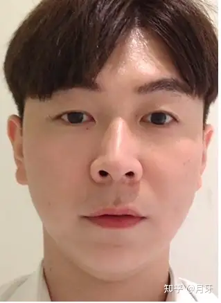 男生提高脸部颜值方法,面部埋线提升怎么样?