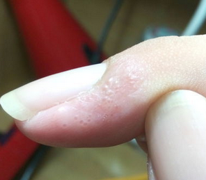 手指长水泡一直不好是湿疹还是手癣还是神马