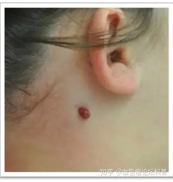 血管瘤系列科普之肉芽肿性血管瘤