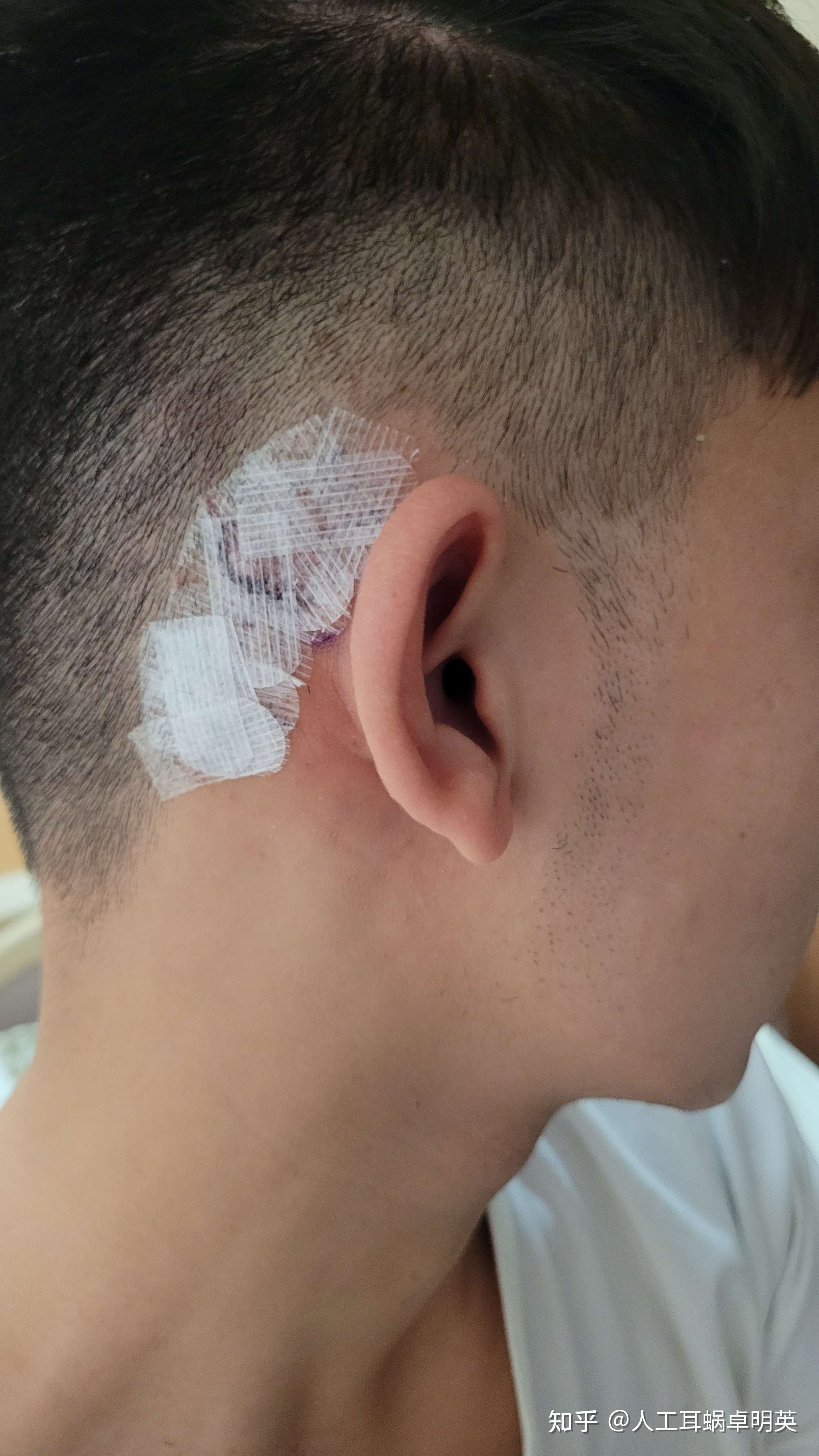 人工耳蜗卓明英 的想法: 成人发际切口人工耳蜗手术,瘢痕基本看不