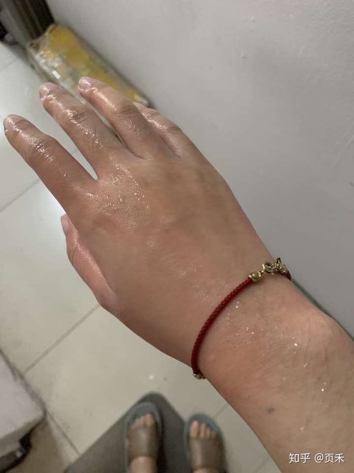 手被开水烫伤恢复记录多图慎入