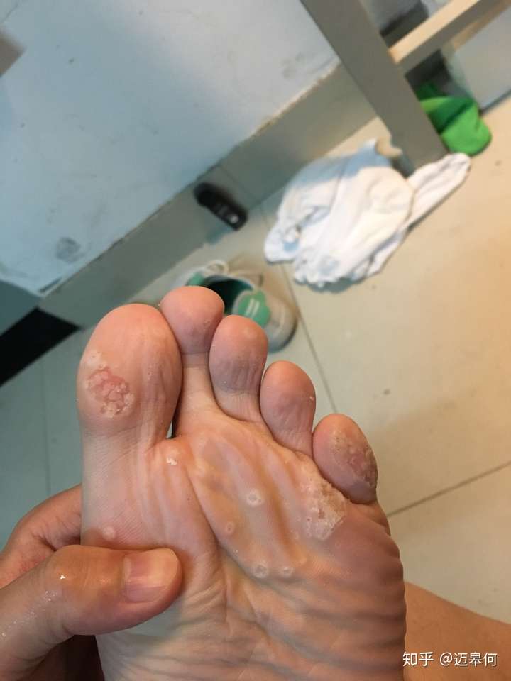脚底长跖疣怎么办