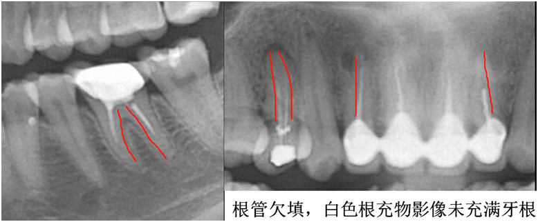 为什么做了根管治疗后牙齿还疼 浅谈根管治疗失败的原因 知乎