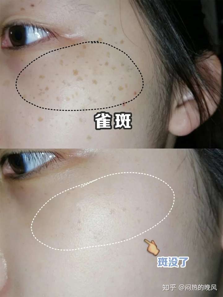 如何去除脸上的雀斑?