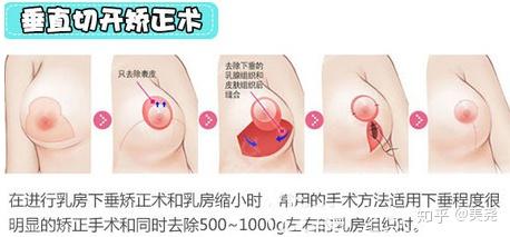 深圳做乳房下垂矫正的五大三甲和整形医院排名
