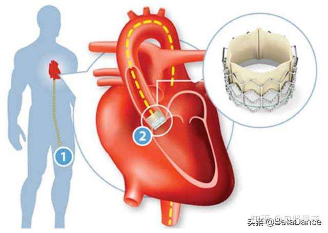 tavr的天花板有多高港股观察启明沛嘉微创