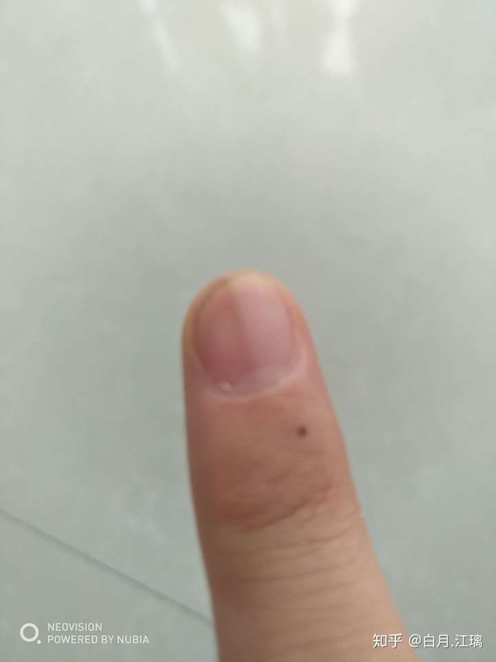 左手大拇指指甲有一条淡褐色竖线好几年了微量元素也正常为什么啊