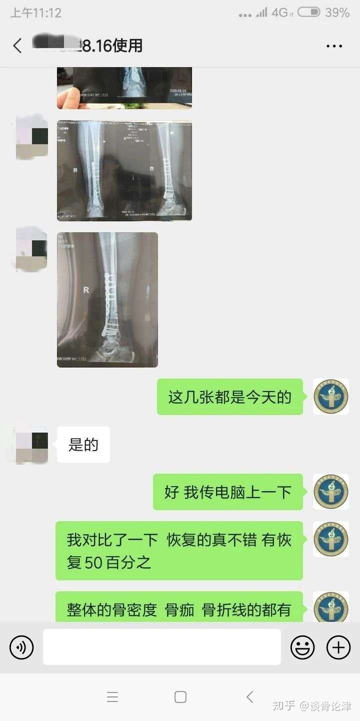 右胫腓骨骨折延迟愈合治疗案例及胫腓骨骨折康复指导 知乎