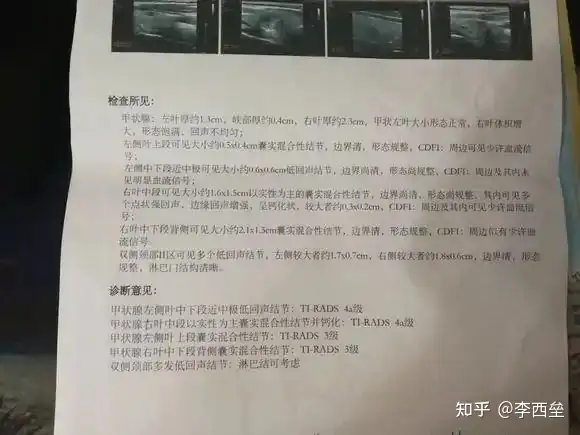中药调理好甲状腺结节，内服+外敷（甲状腺结节中药贴敷方法视频）
