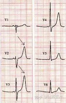 急性缺血性高聳t波(急性冠狀動脈供血不足,心肌梗死超急性期)關於高聳