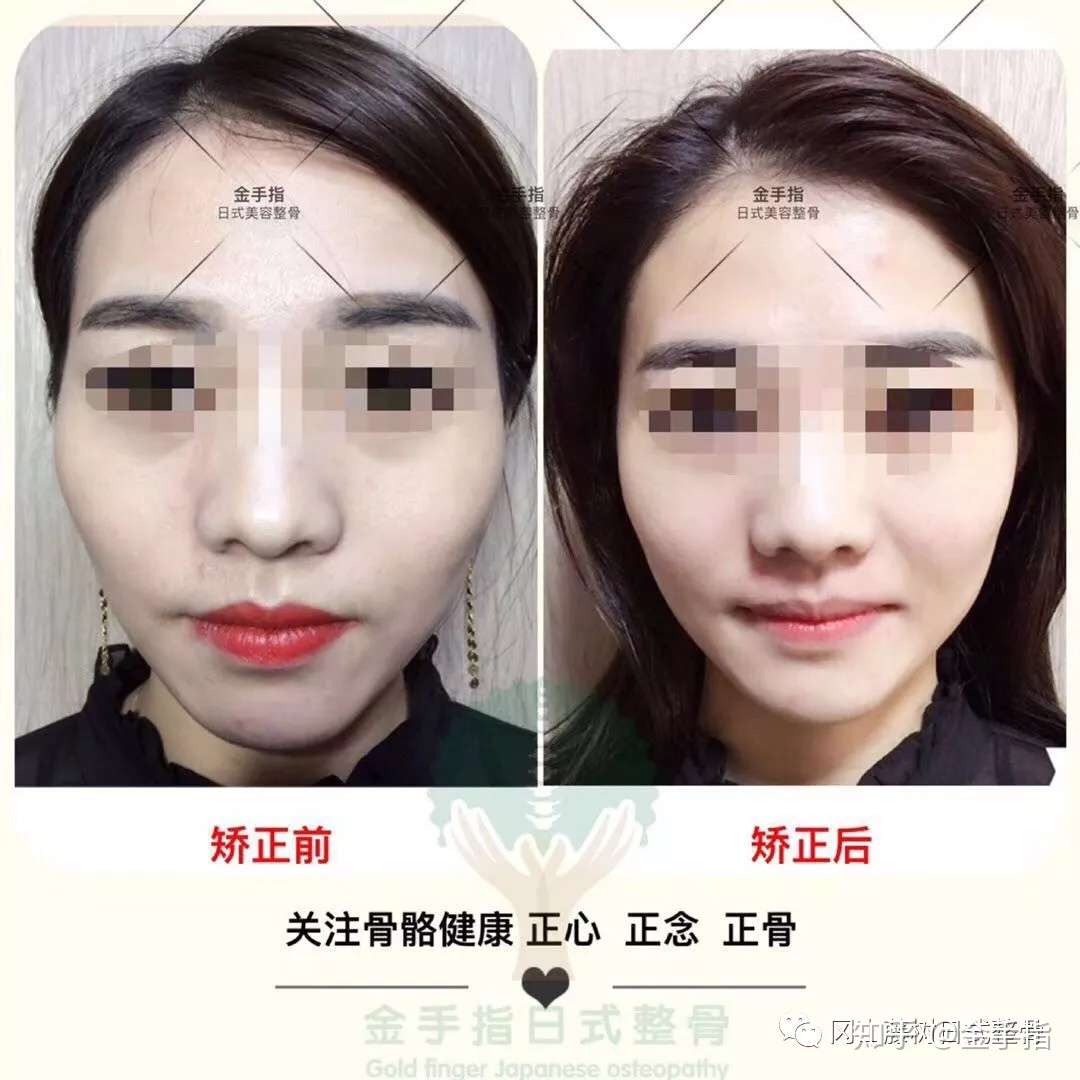 金手指整骨 我们是靠事实说话专业的 知乎