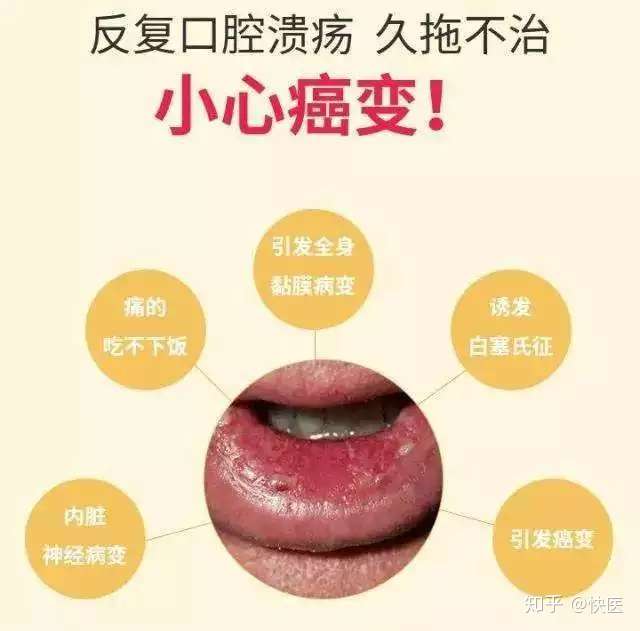 经常口腔溃疡怎么办 看这篇就够了 知乎 经常口腔溃疡怎么办 看这篇就够了 知乎