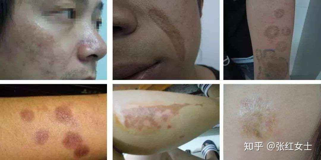 疤痕科普 你疤痕的颜色是不是发黑 知乎