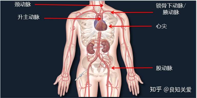 主动脉瓣狭窄了 不用开胸 腿上扎个洞就能治 知乎