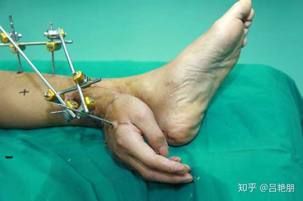 有人问,为什么不直接接回原来的手臂上,暂时不适合接的原因有很多