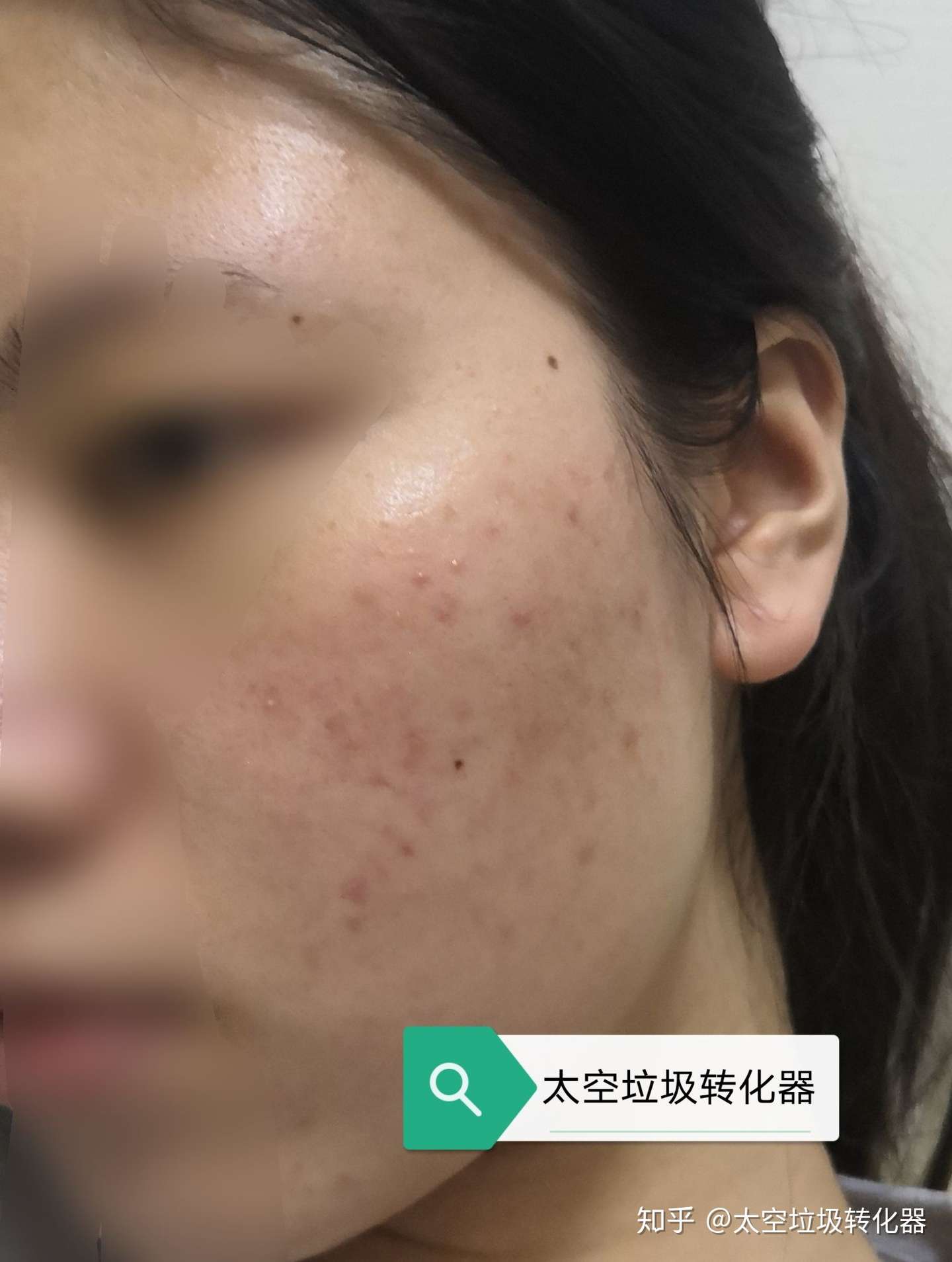 维a乳酸膏记录贴 原相机无滤镜慎入 知乎