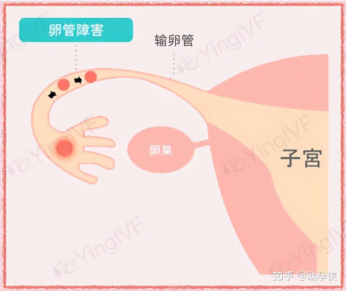 久备不孕 输卵管问题如何应对 知乎