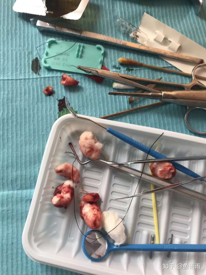 结果拔完,发现磨牙疼,就又去看,原来是锁颌.