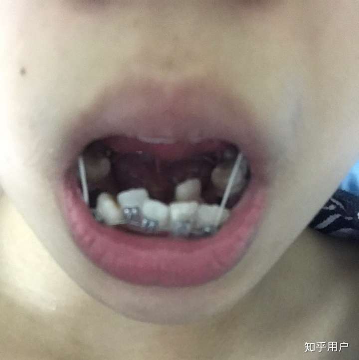 上牙2号3号牙重叠 下牙2号3号挤在一起长 应该做矫正还是把长在内部的