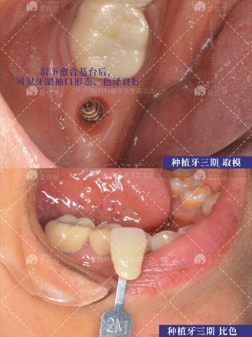 郑州种植牙高功杰 的想法: 右下7号牙缺失患者,种植牙三期取模,比