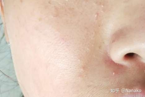 如果是的话,也可能是晚间护肤品太厚重了,皮肤营养过剩.