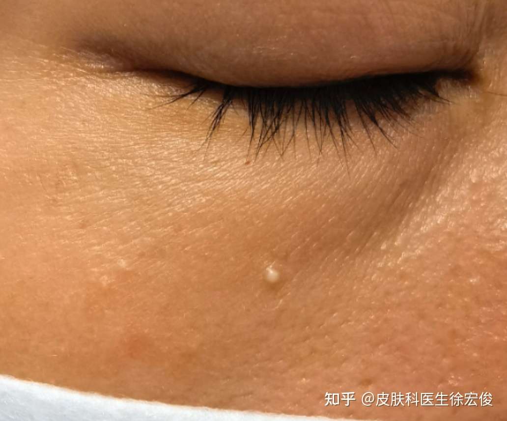 皮徐 的想法: 脸上的脂肪粒就是这颗白色的小丘疹,它的… - 知乎