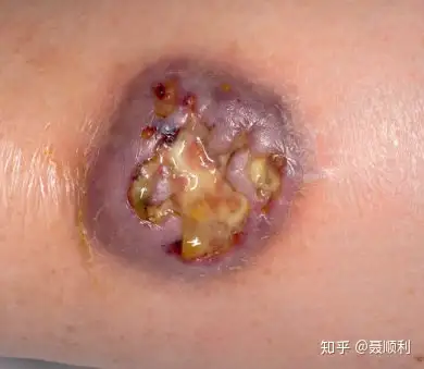 挑战与希望肉芽肿性多血管炎与显微镜下多血管炎中