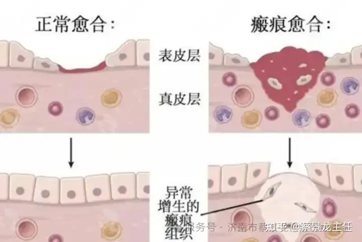 从创伤到修复:瘢痕愈合的每一步,你都该知道! 从创伤到修复:瘢痕愈合的每一步,你都该知道!