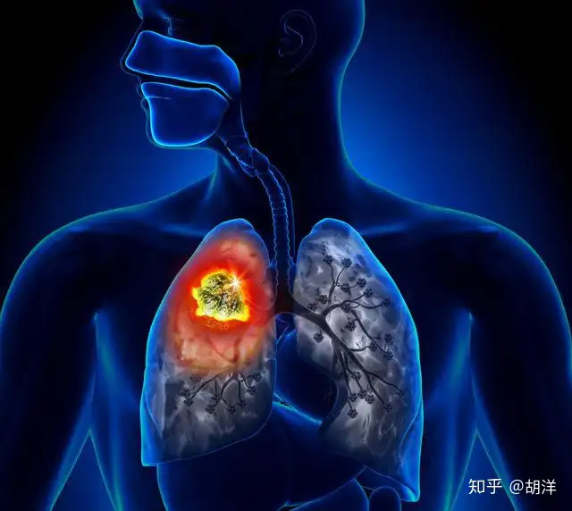 肺癌不治疗会比做治疗活得更久吗？其实有些肺癌已不可算是绝症