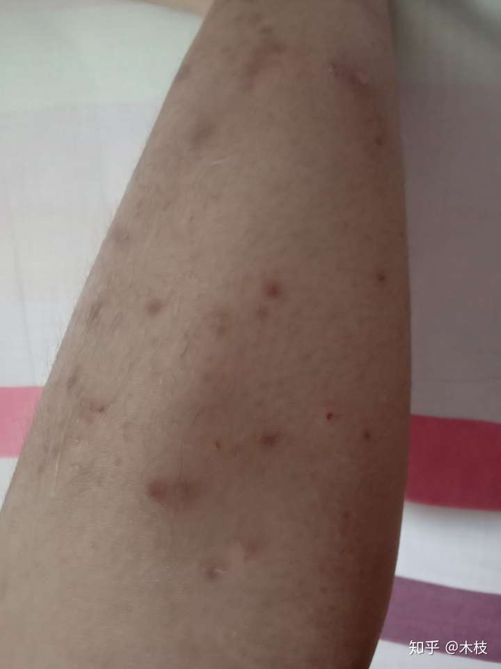 小腿特别痒持续了两个月了一直不好越挠越痒挠破皮结了一腿的疤