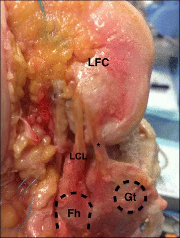 运动损伤--膝外侧副韧带损伤