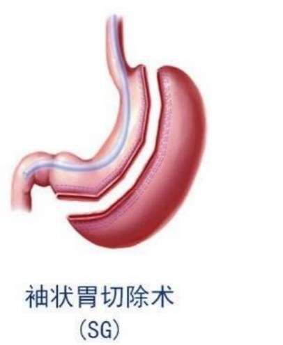 为了减肥就切胃网友甭太天真啦