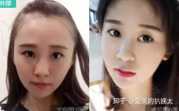 广州植发哪家医院最好(广州植发哪家医院最好最正规碧 莲盛地址)