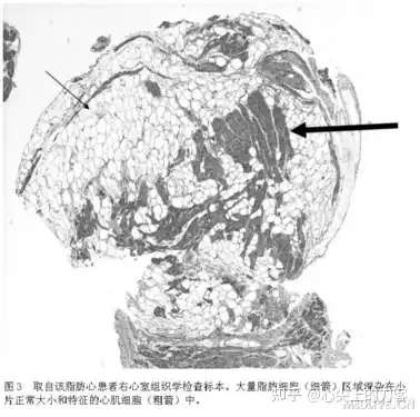 罕见心脏病脂肪心